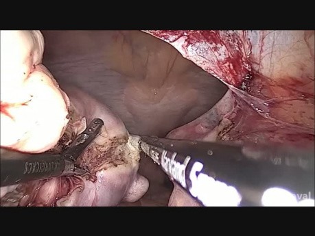 Histerectomía vNOTES para útero con fibromas múltiples (técnica ATRIUM)