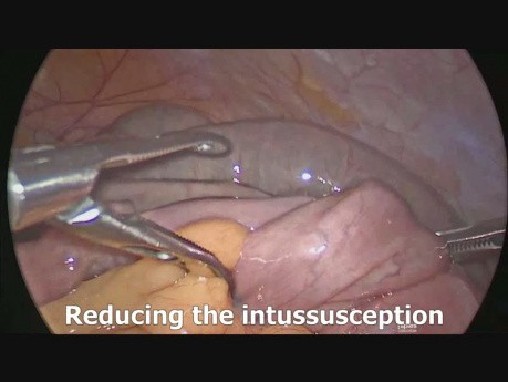 Cirugía laparoscópica de intususcepción