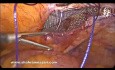 Reparación laparoscópica de hernia inguinal bilateral