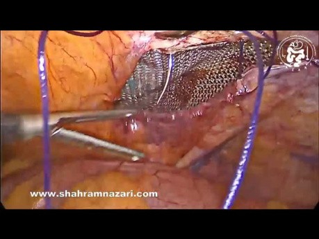 Reparación laparoscópica de hernia inguinal bilateral