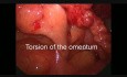 Tratamiento laparoscópico de la torsión del epiplón