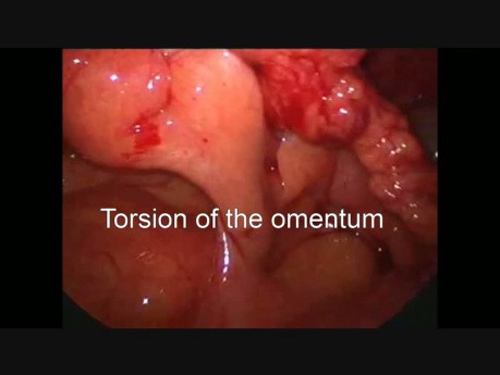 Tratamiento laparoscópico de la torsión del epiplón