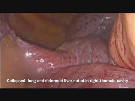 Cirugía laparoscópica de una gran hernia diafragmática postraumática derecha