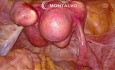 Miomectomía por laparoscopia 3D