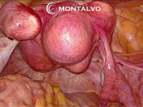 Miomectomía por laparoscopia 3D