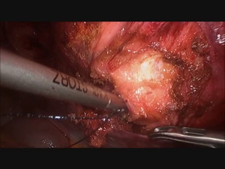 TAPP o TARM - hernioplastia transabdominopreperitoneal/retromuscular en cicatriz postoperatoria