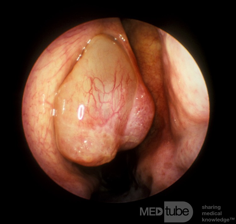 Pólipo nasal