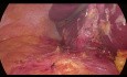 Drenaje Laparoscópico de un Absceso Hepático (segmento 7) y Colecistectomía en un Paciente Súper Obeso (IMC 70)