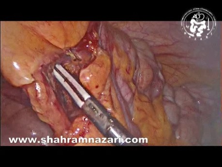 Resección laparoscópica de un mucocele apendicular