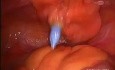 Histerectomía laparoscópica con linfadenectomía pélvica en paciente con IMC = 65