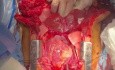 Programa de Rehabilitación Neurológica Transapical (TA NRP) y Donación de Pulmón y Corazón después de la Donación de Órdenes de Muerte Transmisible (DCD)