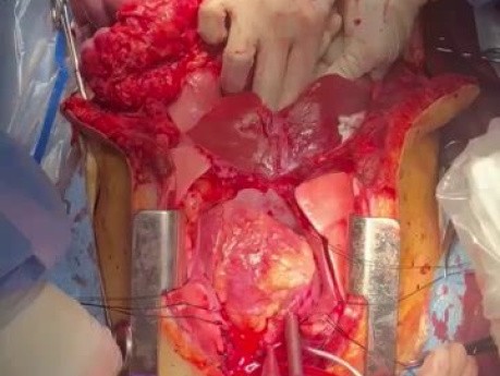 Programa de Rehabilitación Neurológica Transapical (TA NRP) y Donación de Pulmón y Corazón después de la Donación de Órdenes de Muerte Transmisible (DCD)