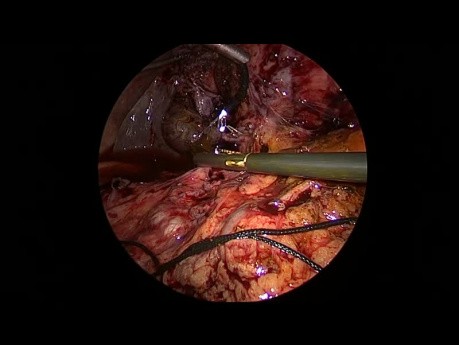 Exploración laparoscópica del conducto biliar común mediante coledocotomía con instrumentos de 3 mm