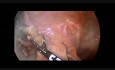 Resección laparoscópica de quiste ovárico izquierdo gigante
