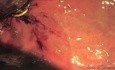 Funduplicatura transoral sin incisión