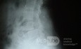 Espondilolistesis 