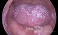 Candidiasis oral