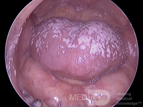 Candidiasis oral