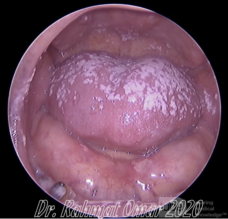 Candidiasis oral