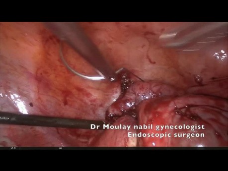 Polimiomectomía laparoscópica compleja