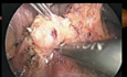 Tumores endocrinos del páncreas