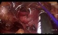 Reparación de la vena cava durante la nefrectomía parcial retroperitoneoscópica