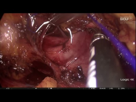 Reparación de la vena cava durante la nefrectomía parcial retroperitoneoscópica