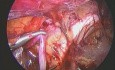 Varicocelectomía izquierda laparoscópica 