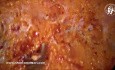 Reparación con malla SCOLA para hernia umbilical