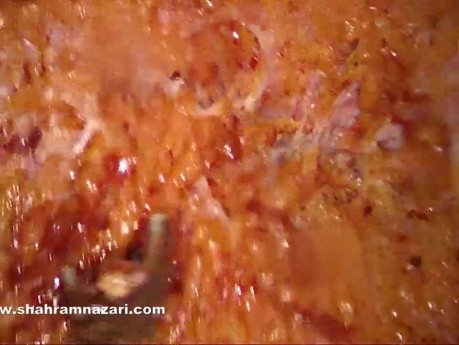 Reparación con malla SCOLA para hernia umbilical