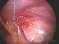Anatomía del canal inguinal en vista laparoscópica