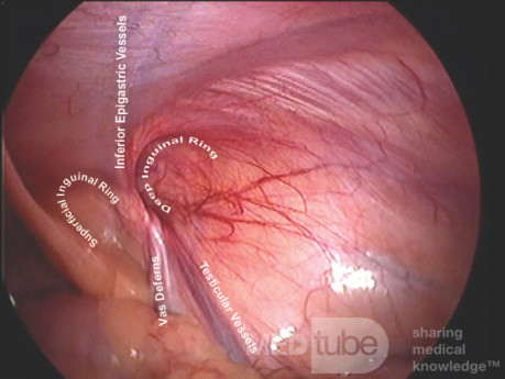 Anatomía del canal inguinal en vista laparoscópica