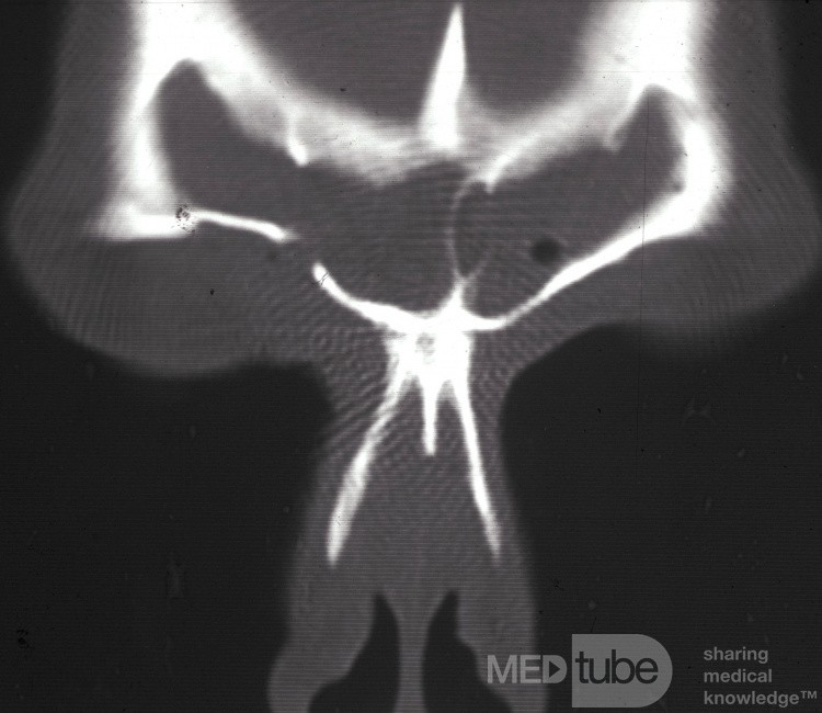 Fístula del seno frontal derecho posterior a la trepanación [tomografía computarizada]