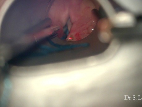 Cirugía de parálisis bilateral de cuerdas vocales 