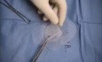 Reparación de hernia inguinal