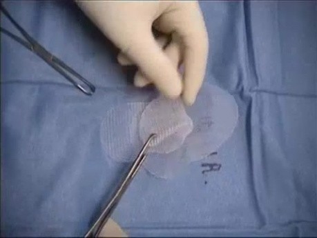 Reparación de hernia inguinal