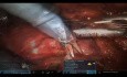 Nefrectomía parcial asistida por robot en un riñón en herradura