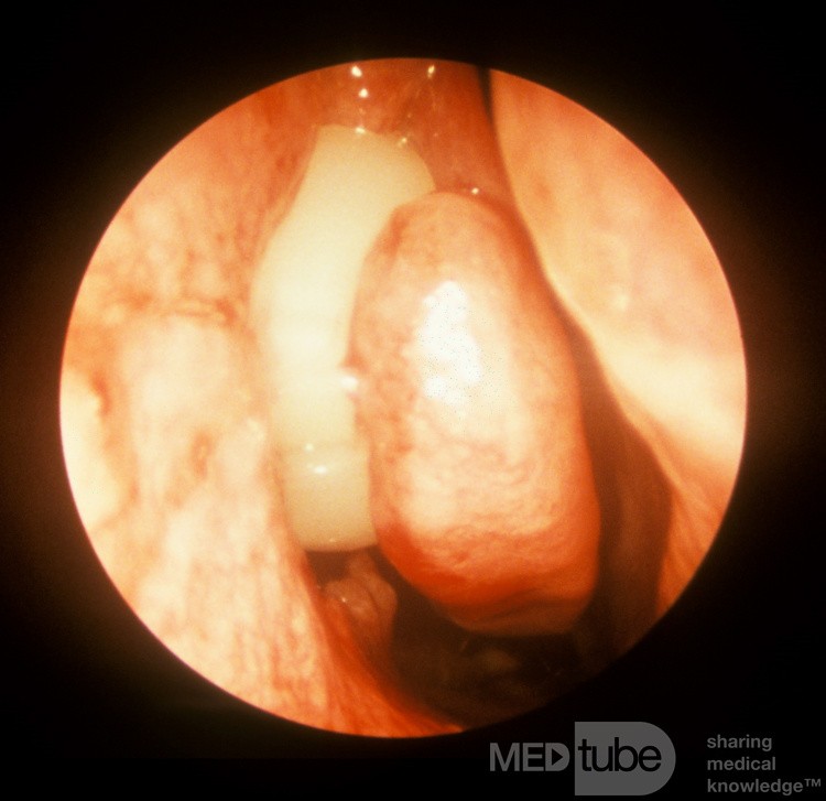 Celulitis orbitaria temprana, vista intraoperatoria [derecha]