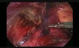 Reparación laparoscópica TAPP de hernia inguinal (trocar de 5 mm)