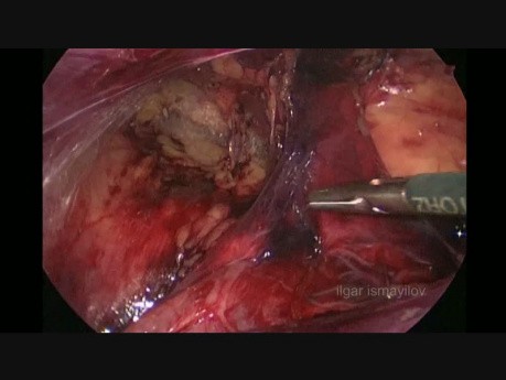 Reparación laparoscópica TAPP de hernia inguinal (trocar de 5 mm)