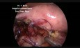 Reparación laparoscópica de una perforación colonoscópica iatrogénica