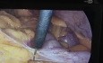 Gastrectomia total radical d2 laparoscopica por nm gastrico