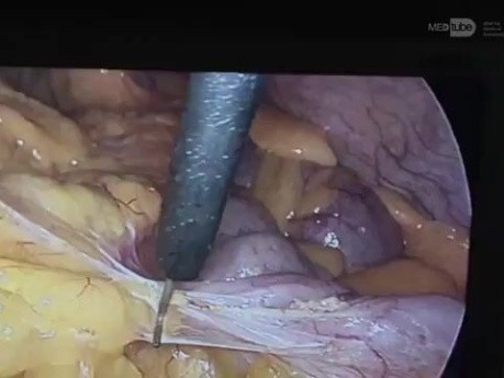 Gastrectomia total radical d2 laparoscopica por nm gastrico