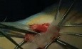 PHS - reparación de hernia inguinal