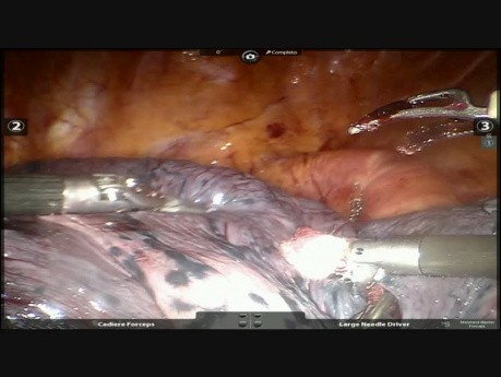 Carcinosarcoma del bronquio izquierdo