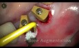 Extracción e implantación inmediata con láser