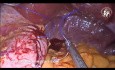 Gastrectomía en manga laparoscópica con omentopexia y fijación de la pared posterior gástrica para desenroscar el estómago remanente