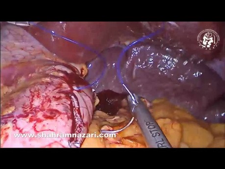 Gastrectomía en manga laparoscópica con omentopexia y fijación de la pared posterior gástrica para desenroscar el estómago remanente