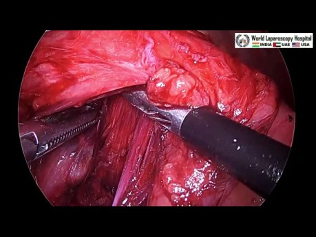 Funduplicatura laparoscópica     