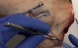 Cirugía de cáncer de piel: el colgajo romboidal